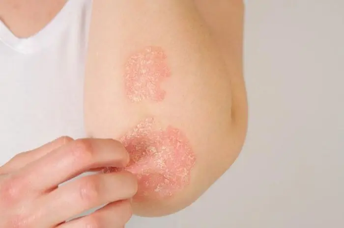 Cara Mengobati Psoriasis untuk Kualitas Hidup Lebih Baik